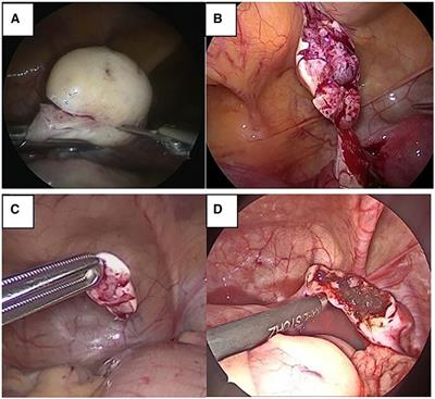 Laparoscopic ovarian tissue collection for fertility preservation in children with malignancies: a multicentric experience